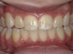 white spots on gums